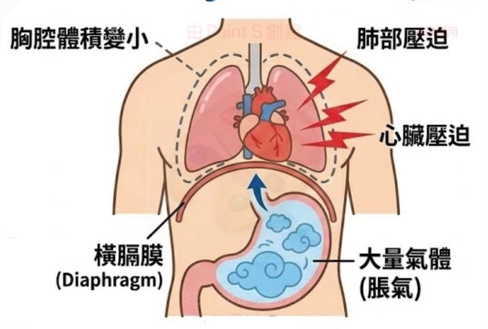 胃部、橫膈膜及胸腔相對位置的示意圖