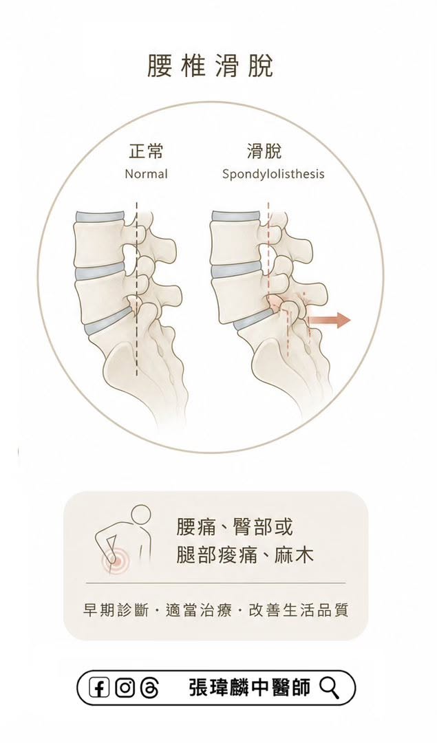 正常腰椎與腰椎滑脫的對照示意圖