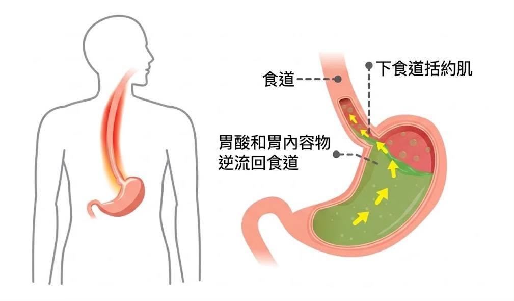 食道、胃與下食道括約肌及胃內容物逆流方向的示意圖